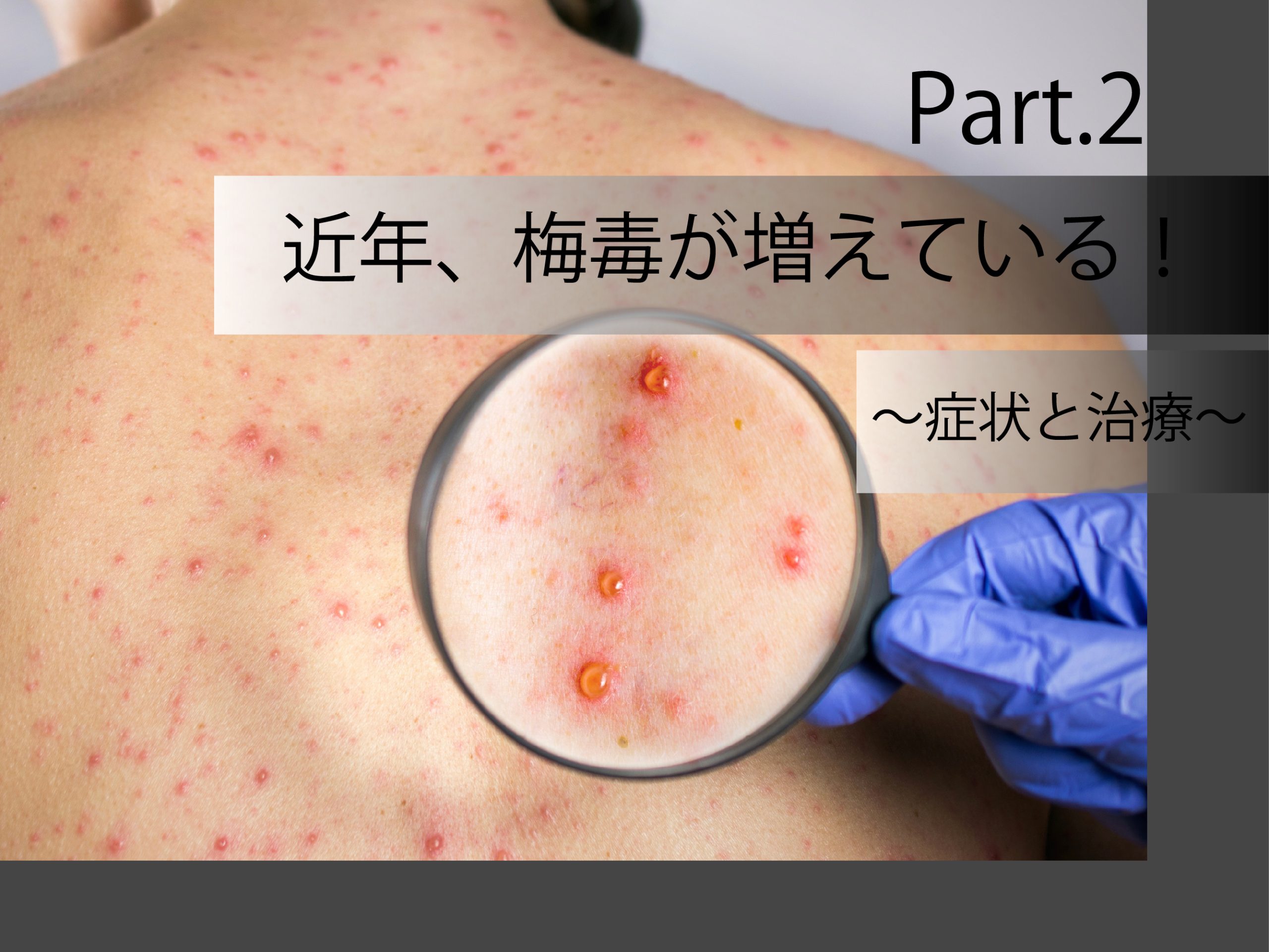 近年、梅毒が増えている!
